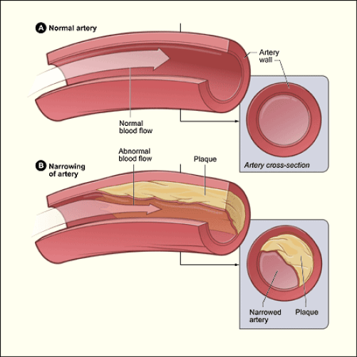 Difference Between Atherosclerosis and Thrombosis