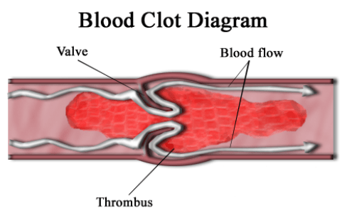 Main Difference - Atherosclerosis vs Thrombosis