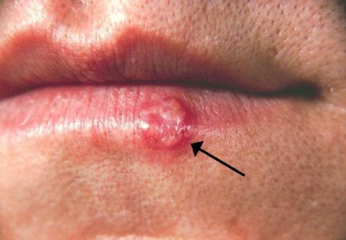 Difference Between Cold Sore and Canker Sore