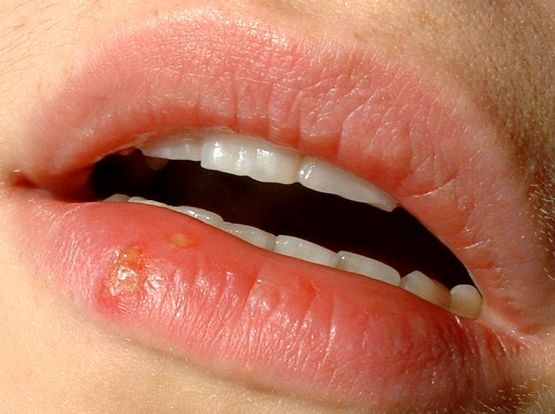 Difference Between Cold Sore and Fever Blister 