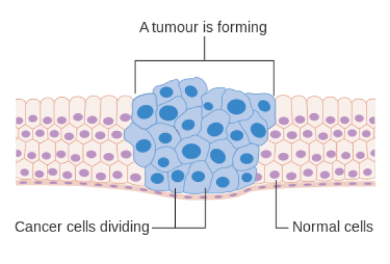 Main Difference - Cyst vs Tumor