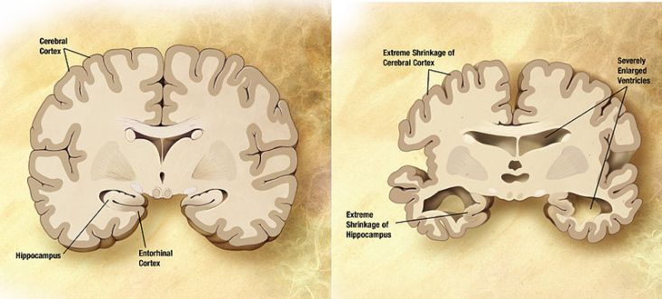 Main Difference - Dementia vs Delirium