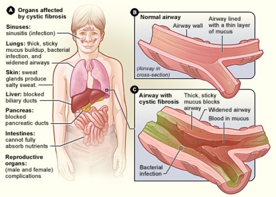 Difference Between Fibrosis and Cirrhosis
