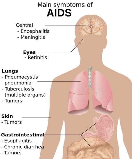 Difference Between HIV and AIDS 