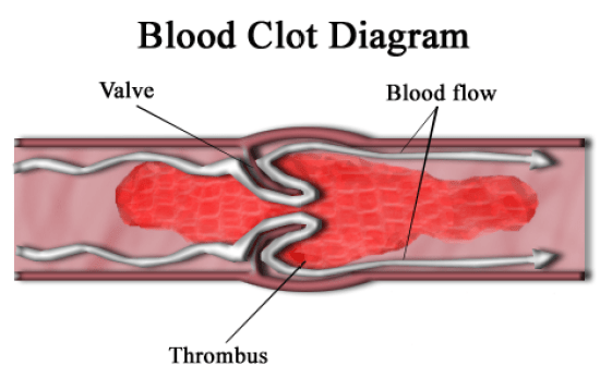 Difference Between Haemostasis and Thrombosis