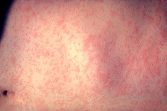 Main Difference - Measles vs German Measles