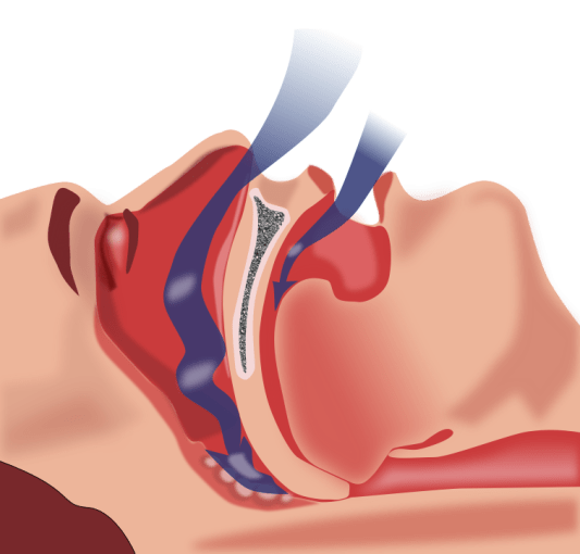 Difference Between Narcolepsy and Sleep Apnea 