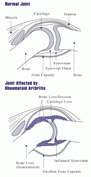 Main Difference - Osteoarthritis vs  Rheumatoid Arthritis