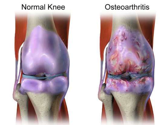 Difference Between Osteoarthritis and Rheumatoid Arthritis