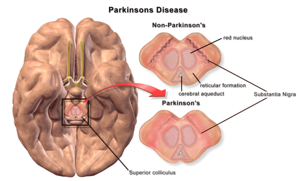 Difference Between Parkinsonism and Parkinson’s Disease