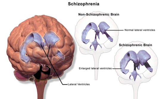 Difference Between Schizophrenia and Schizoaffective Disorder