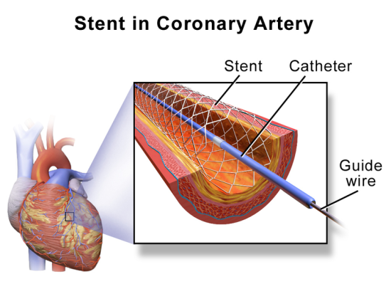 Difference Between Stent and Catheter