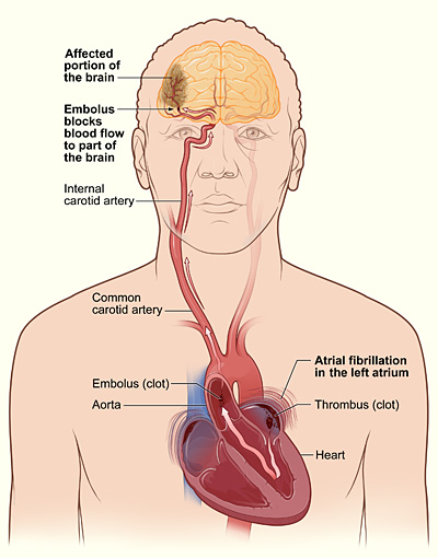Main Difference - Tachycardia vs Atrial Fibrillation