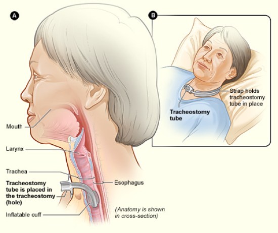 Difference Between Tracheotomy and Tracheostomy 