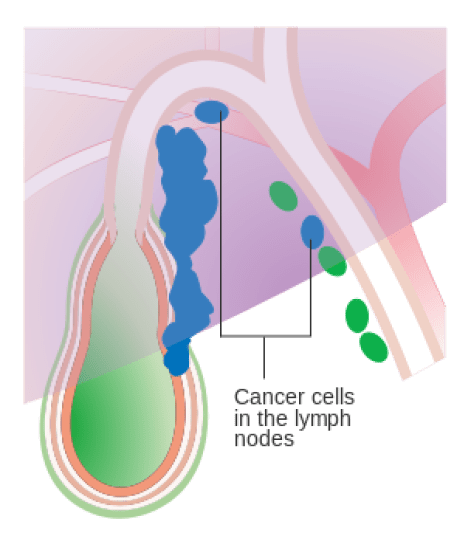 How Do Cancer Cells Spread - 2