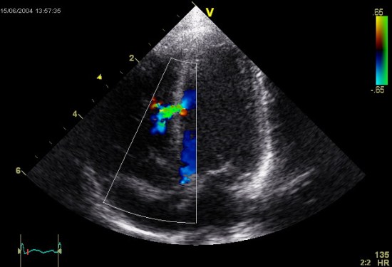 What Does an Echocardiogram Show - 1