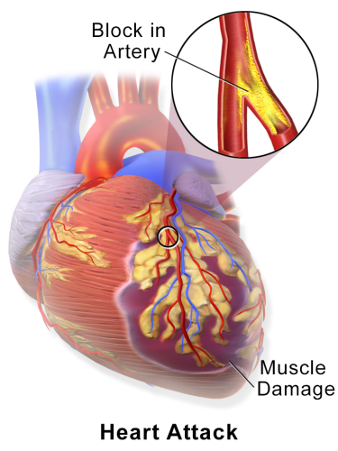 What is a Myocardial Infarction, What Causes a Myocardial Infarction_2
